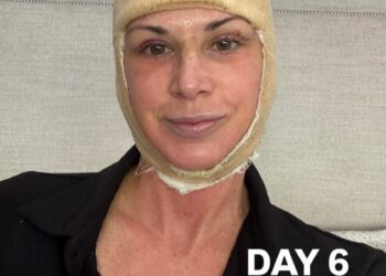 RHOC’s Alexis Bellino Reveals Facelift Results, Details ‘Brutal’ Recovery