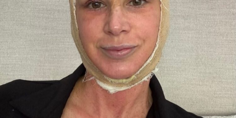 RHOC’s Alexis Bellino Reveals Facelift Results, Details ‘Brutal’ Recovery