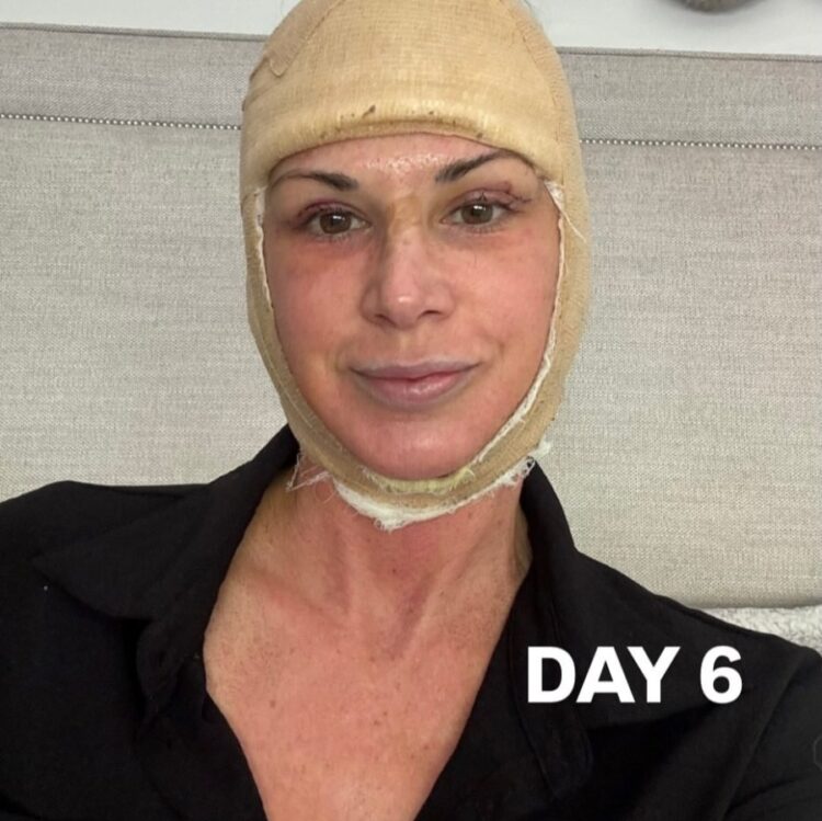 RHOC’s Alexis Bellino Reveals Facelift Results, Details ‘Brutal’ Recovery